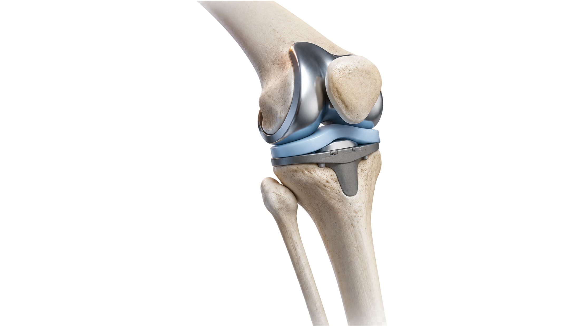 Knee rehabilitation after total knee replacement